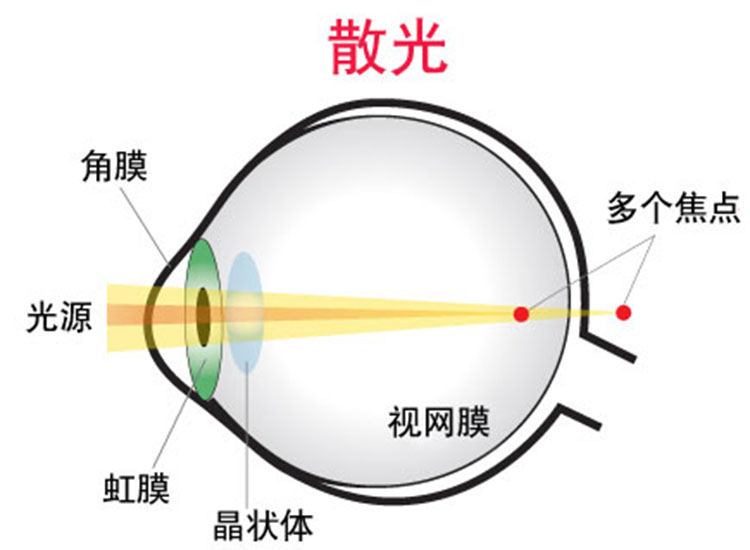 看到路灯散出几道光线就是散光吗?