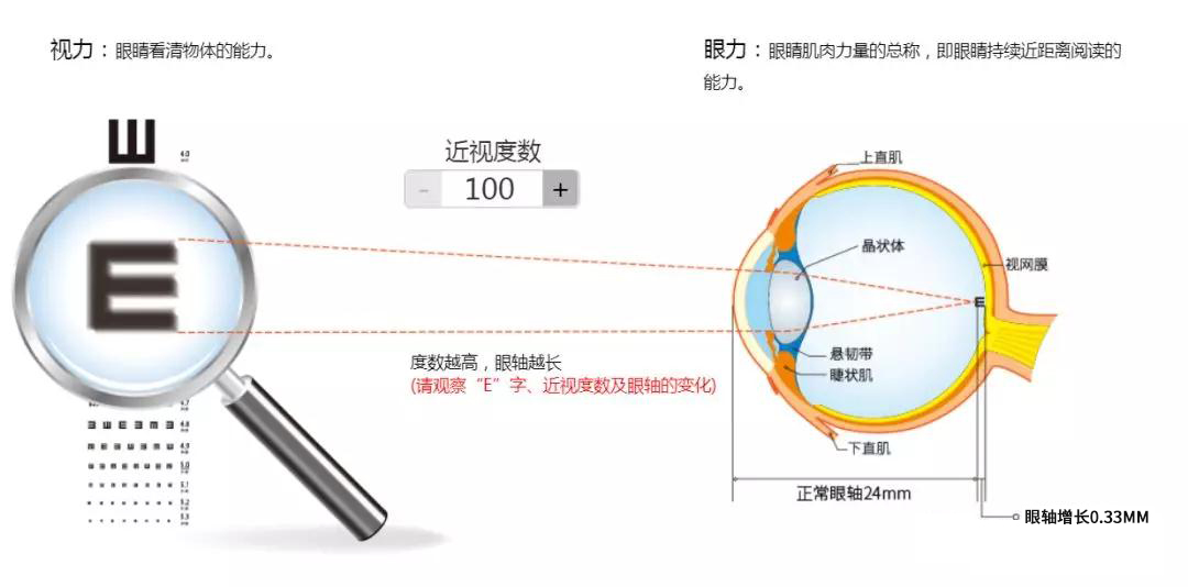 科普:近视100度—1500度看物体清晰度及眼轴的变化