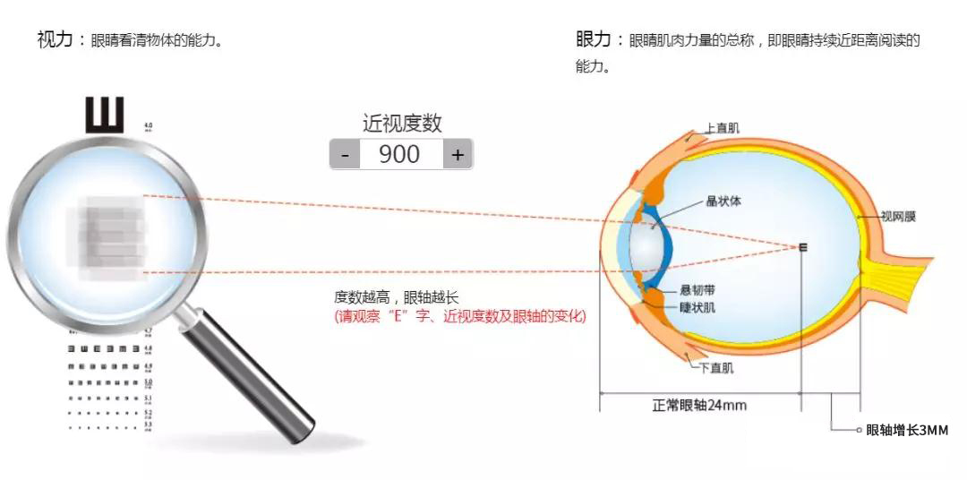 科普:近视100度—1500度看物体清晰度及眼轴的变化