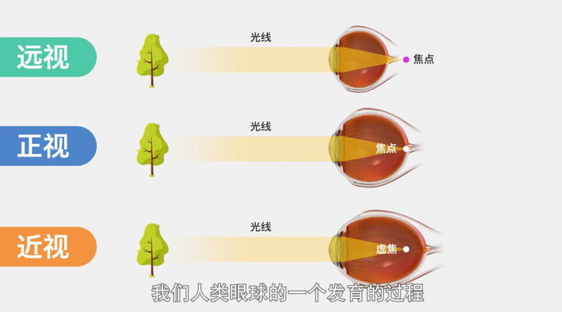 科普 眼轴长度评估在近视防控中的重要作用!