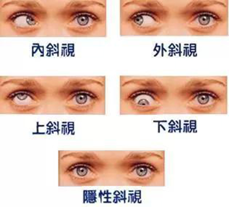 眼球发育特点使儿童易患斜视