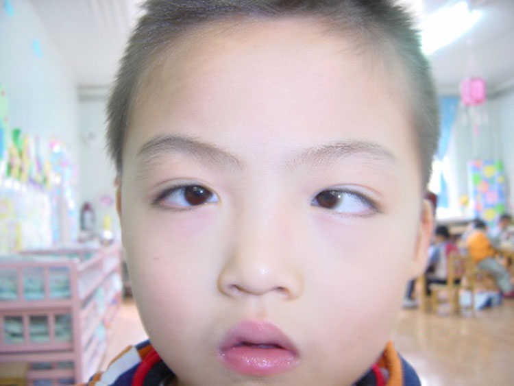 儿童斜视发病率仅次于近视,不可无视它的存在